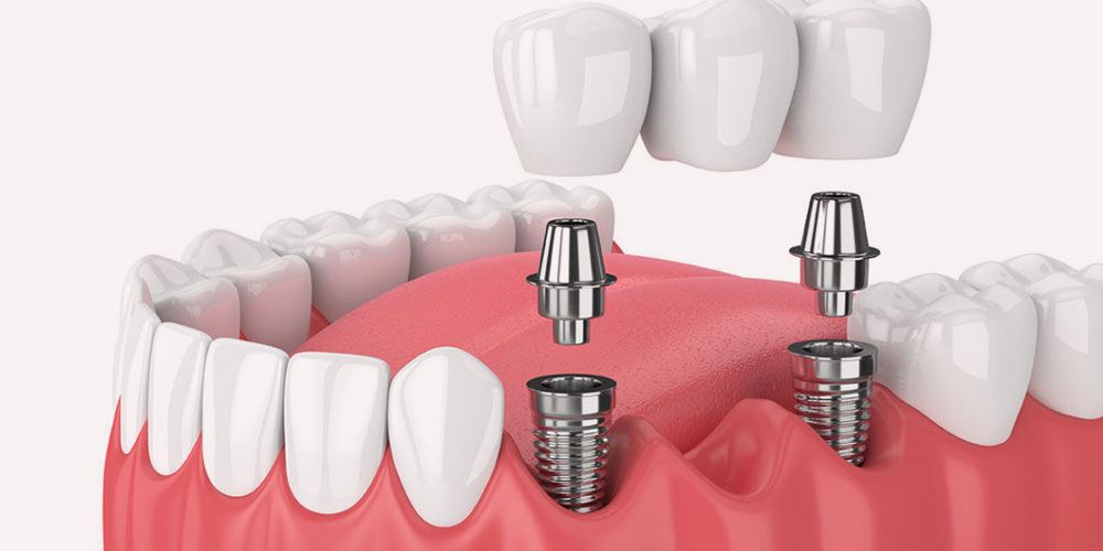 Dental Implants Ghatkopar East Mumbai India